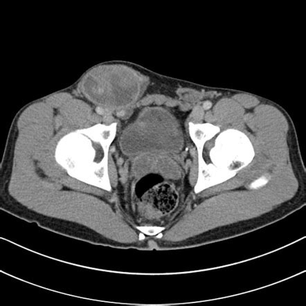 testicle in inguinal canal radiology